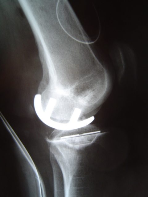 Unicondylar Knee Replacement